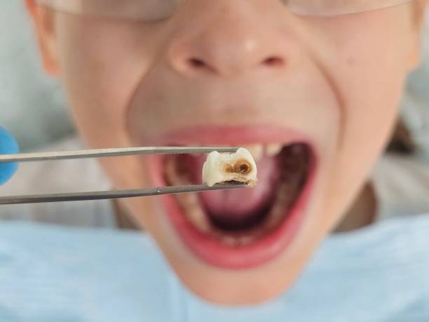 Best Urgent Care for Lost Fillings or Crowns in Los Altos Hills, CA
