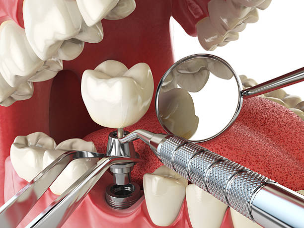Best Emergency Dental Care for Broken or Chipped Teeth in Los Altos Hills, CA